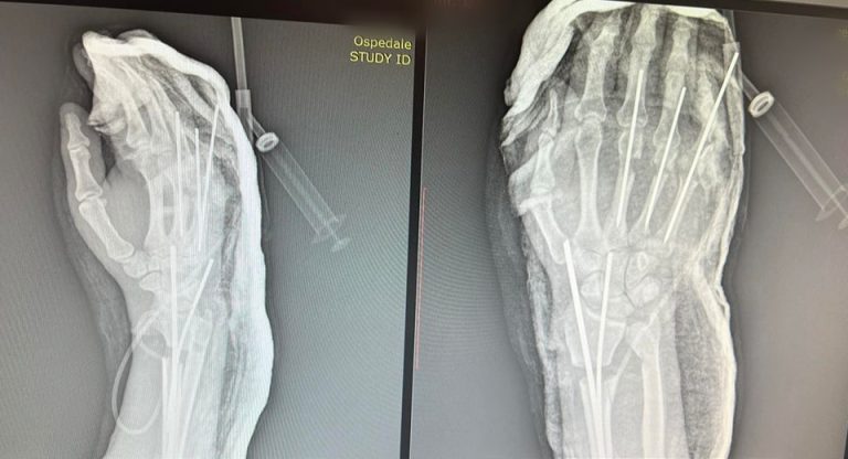 Spitali Universitar në Kosovë kryen me sukses një operacion të rrallë, 27-vjeçarit i shpëtohet parakrahu i prerë